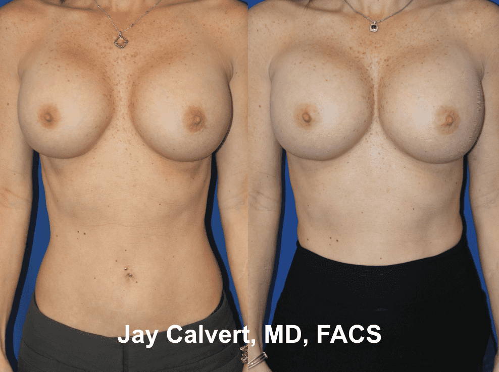 Removal & Replacement of Breast Implants by Dr. Calvert