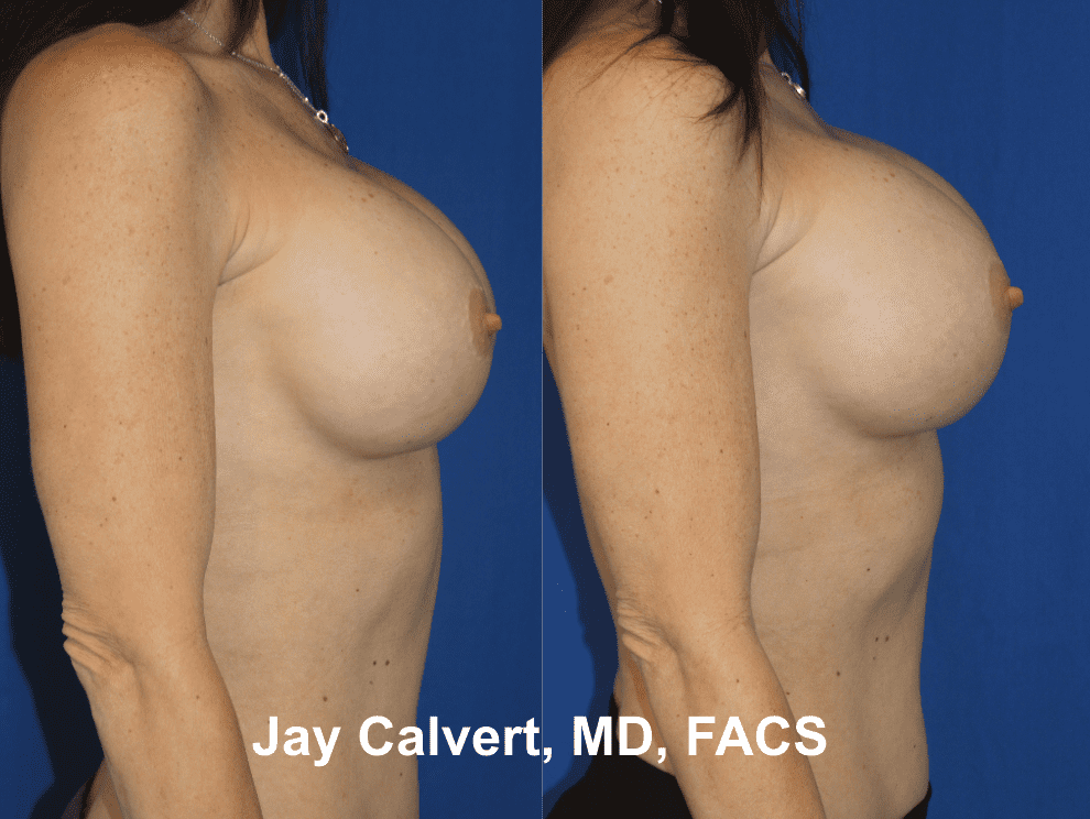 Removal & Replacement of Breast Implants by Dr. Calvert 1a