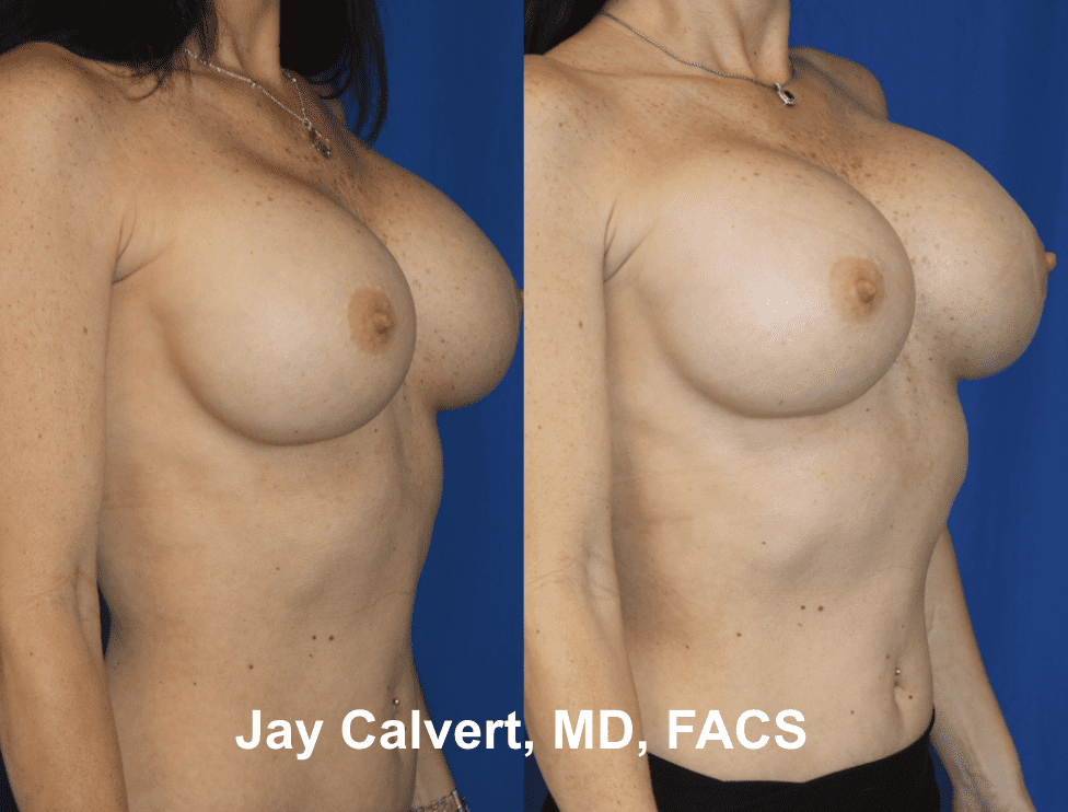 Removal & Replacement of Breast Implants by Dr. Calvert 4f