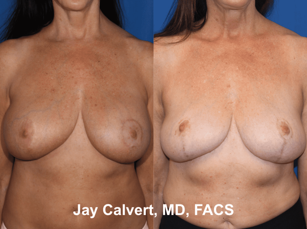 Explantation + Mastopexy by Dr. Calvert