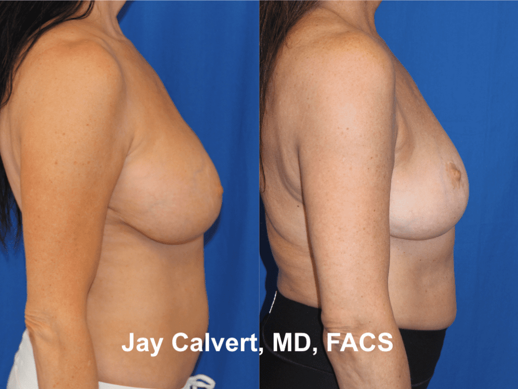 Explantation + Mastopexy by Dr. Calvert 1a