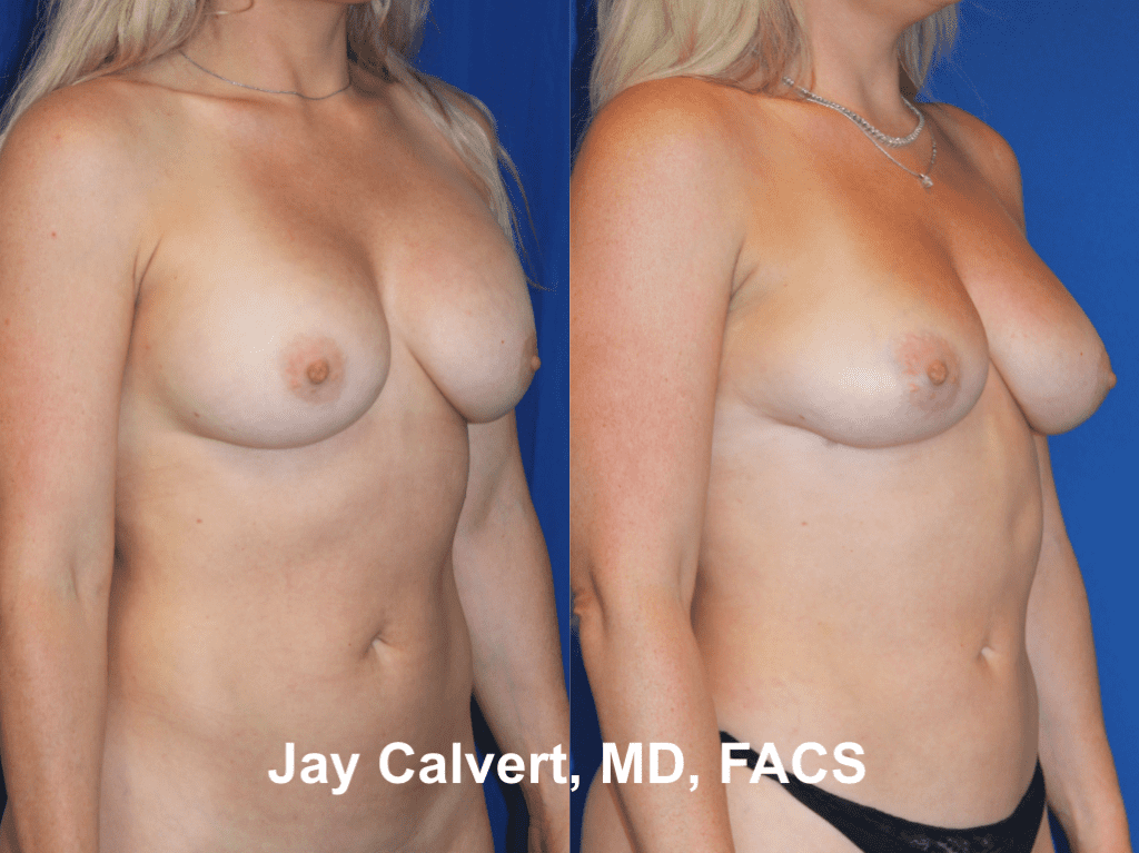 Explantation + Fat Grafting by Dr. Jay Calvert 5h