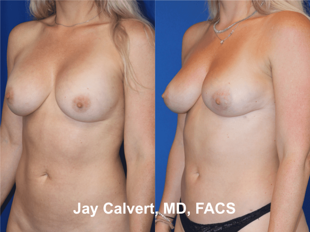Explantation + Fat Grafting by Dr. Jay Calvert 5j