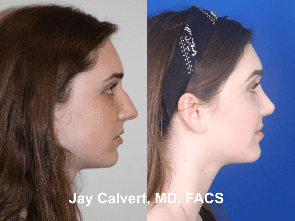Primary Teenage Septorhinoplasty by Dr. Calvert 2a
