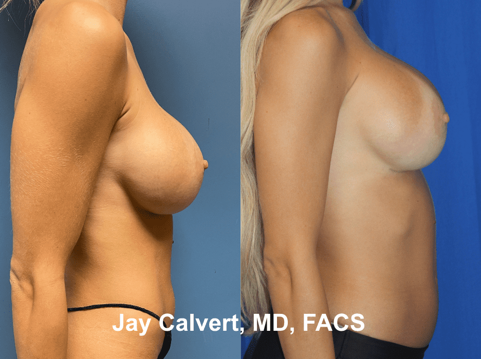 Breast Implant Removal & Replacement by Dr. Jay Calvert 4b
