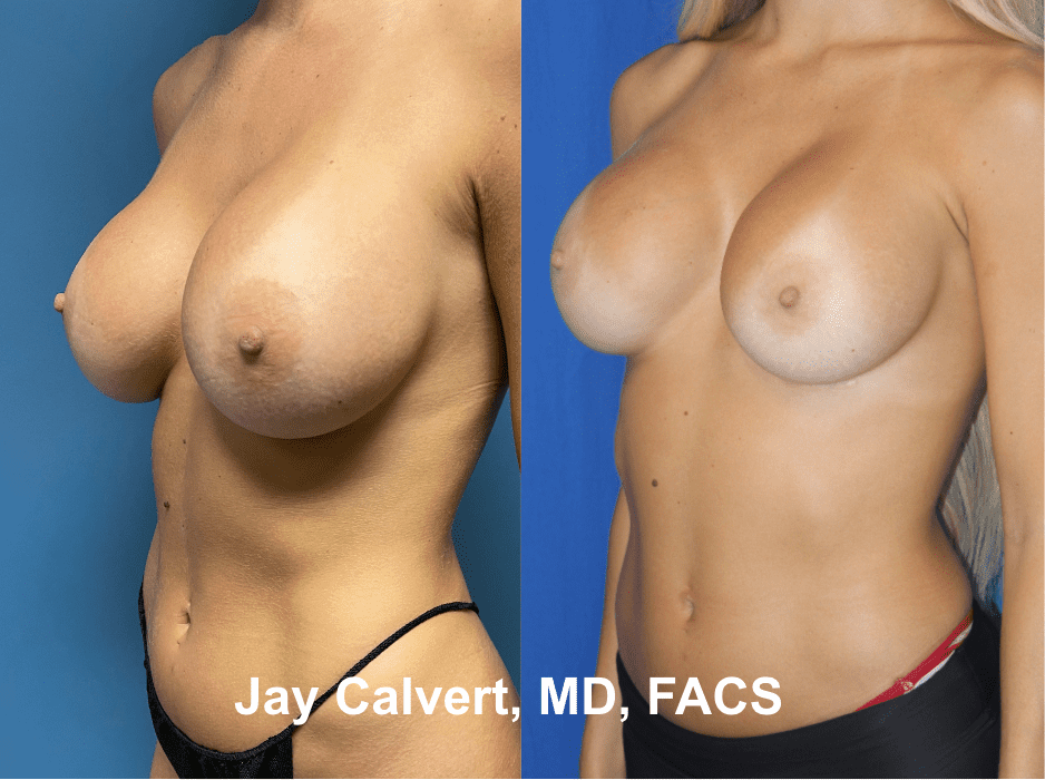 Breast Implant Removal & Replacement by Dr. Jay Calvert