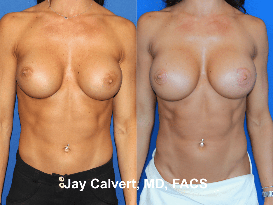 Breast Implant Exchange by Dr. Jay Calvert 2g