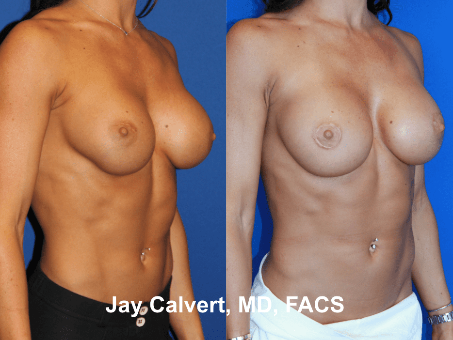 Breast Implant Exchange by Dr. Jay Calvert 2f
