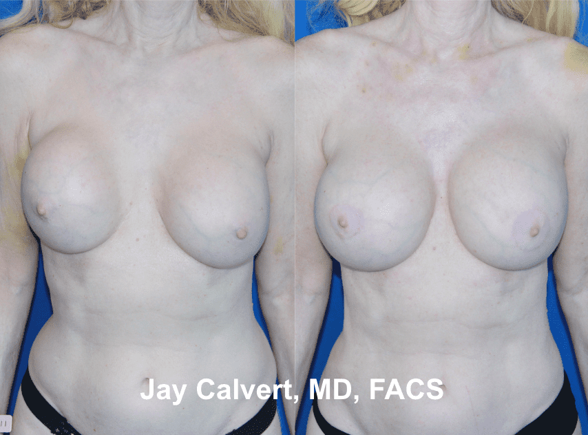 Breast Implant Exchange by Dr. Jay Calvert 2d