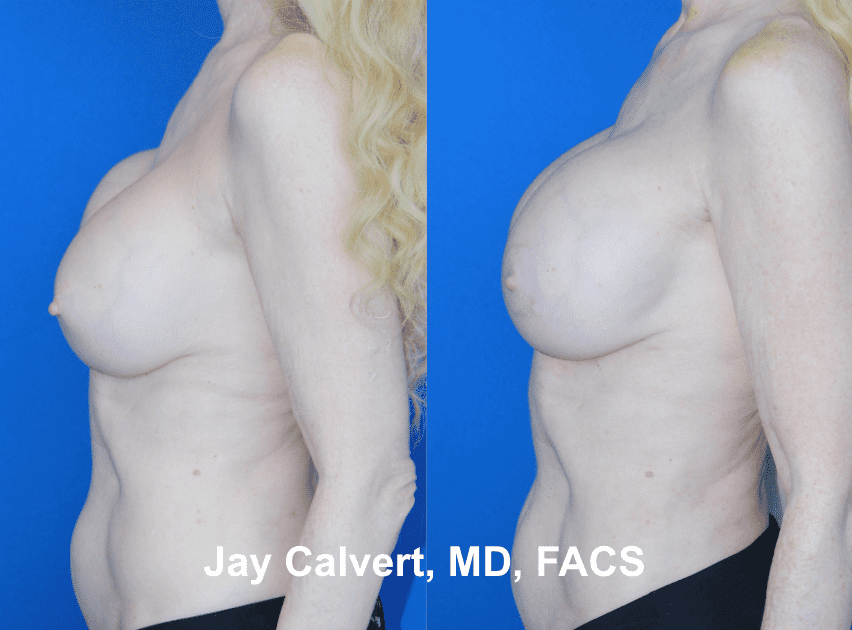 Breast Implant Exchange by Dr. Jay Calvert 1a