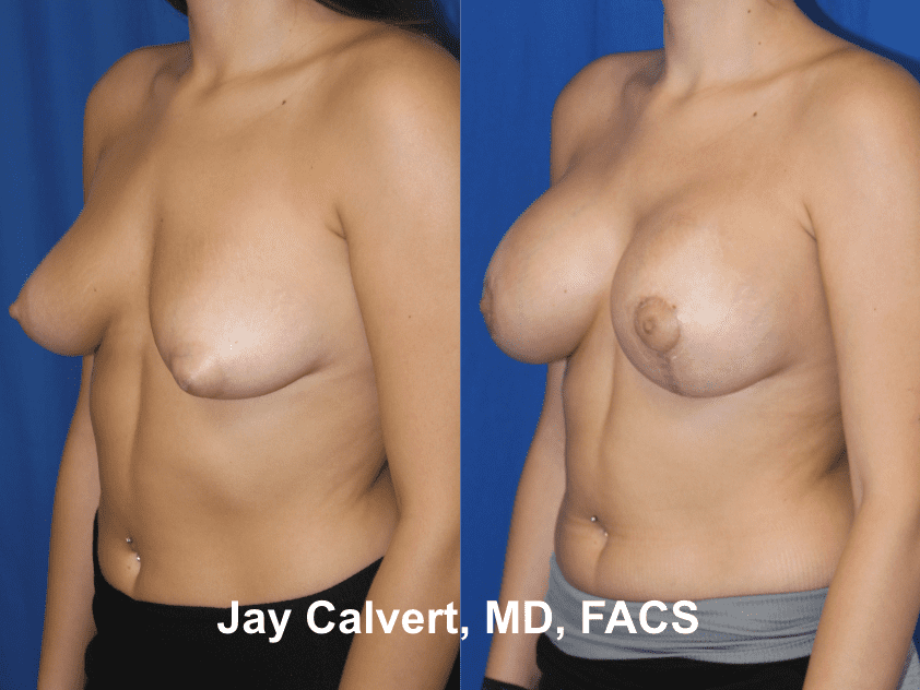 Breast Augmentation by Dr. Jay Calvert 6d