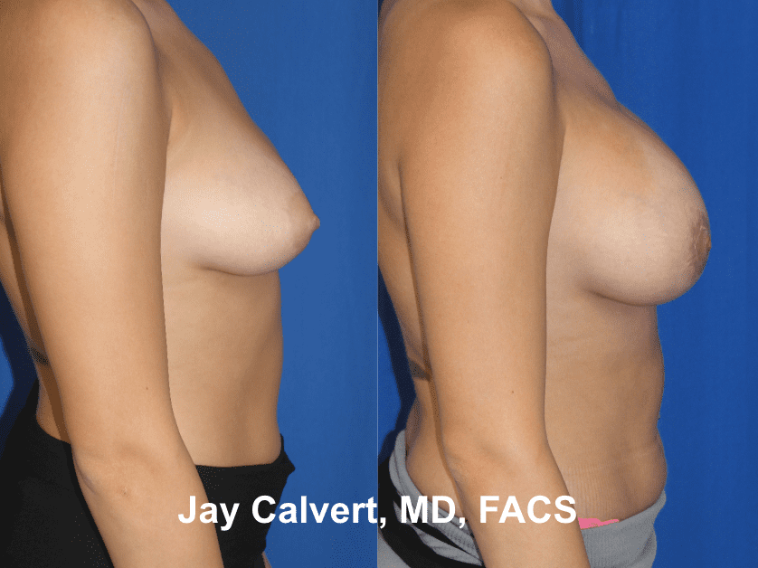 Breast Augmentation by Dr. Jay Calvert 5d