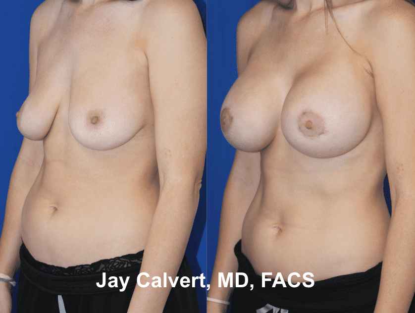 Breast Augmentation by Dr. Jay Calvert 1d