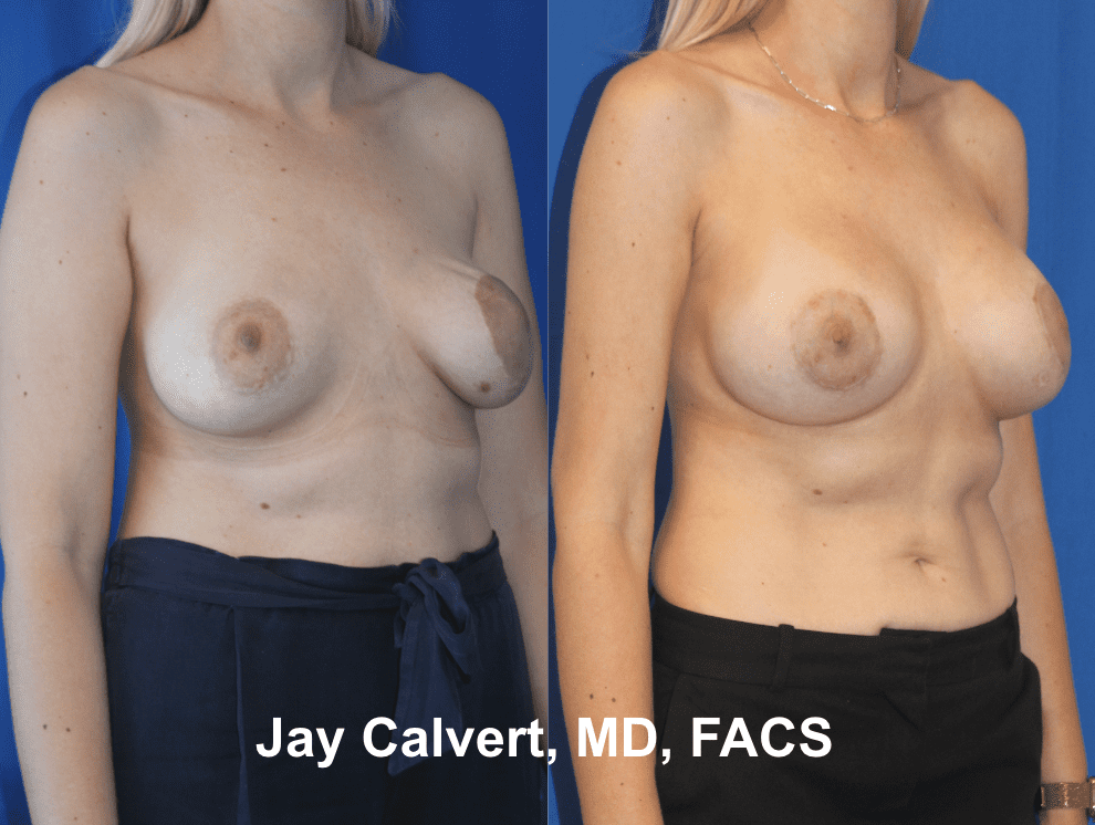 Breast Revision by Dr. Jay Calvert 3