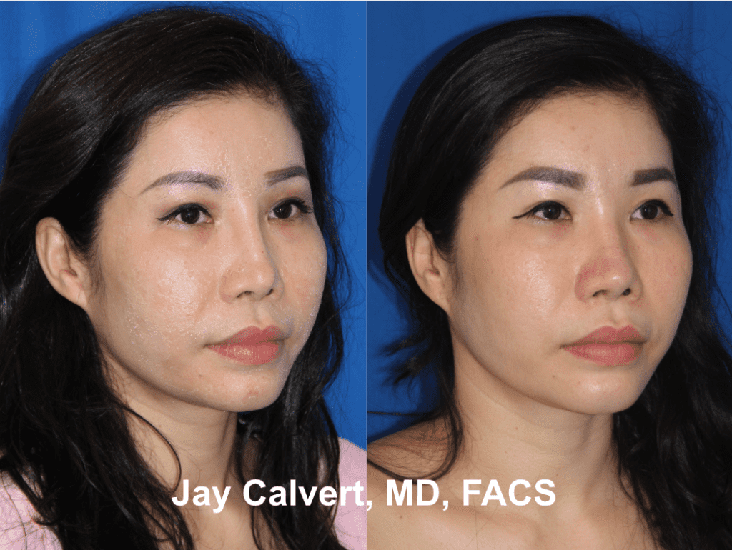 Revision Rhinoplasty with Rib by Dr. Calvert 2