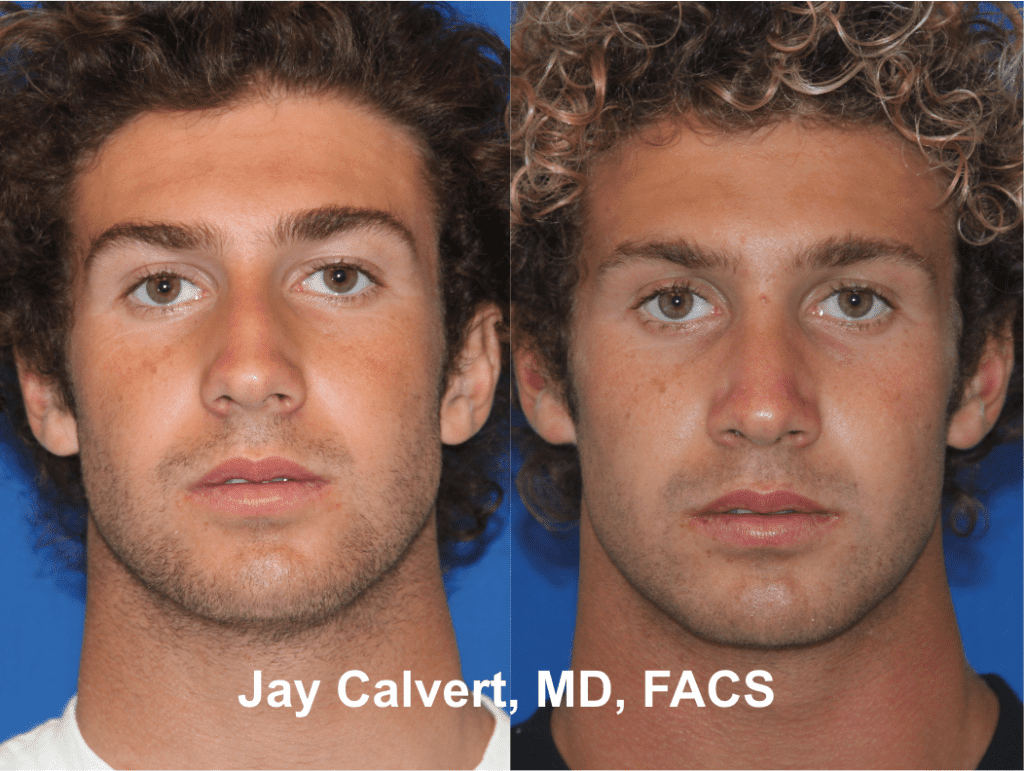 Primary Septorhinoplasty by Dr. Jay Calvert 1