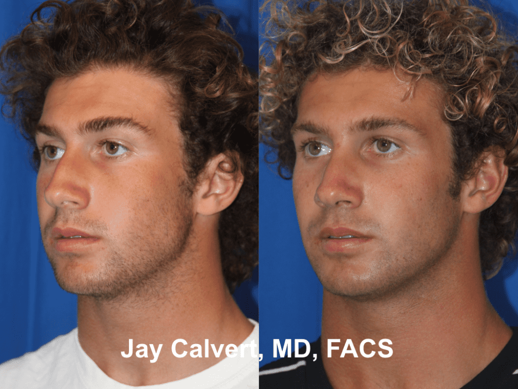 Primary Septorhinoplasty by Dr. Jay Calvert 4