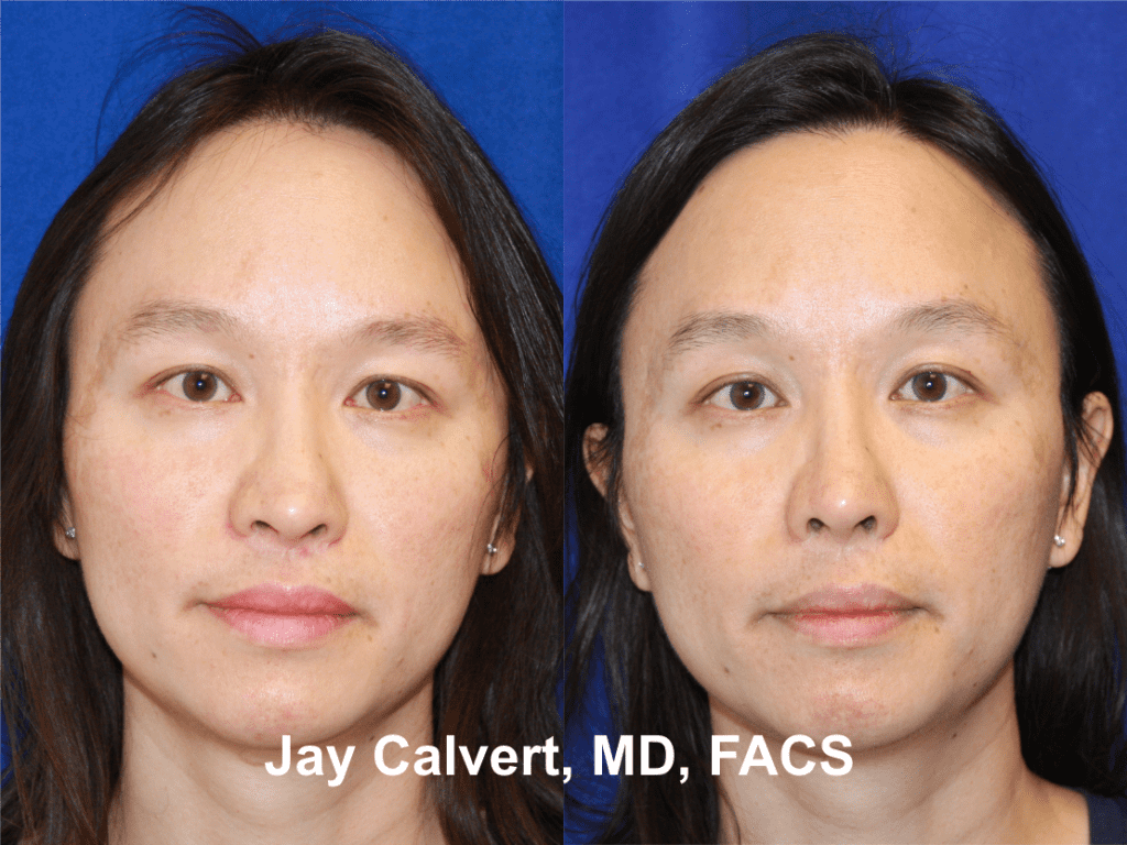 Revision Rhinoplasty with Rib by Dr. Calvert 8