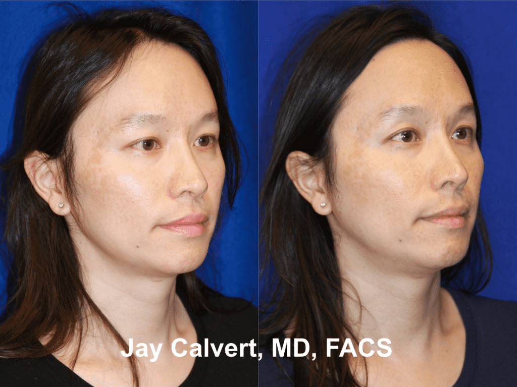 Revision Rhinoplasty with Rib by Dr. Calvert 6