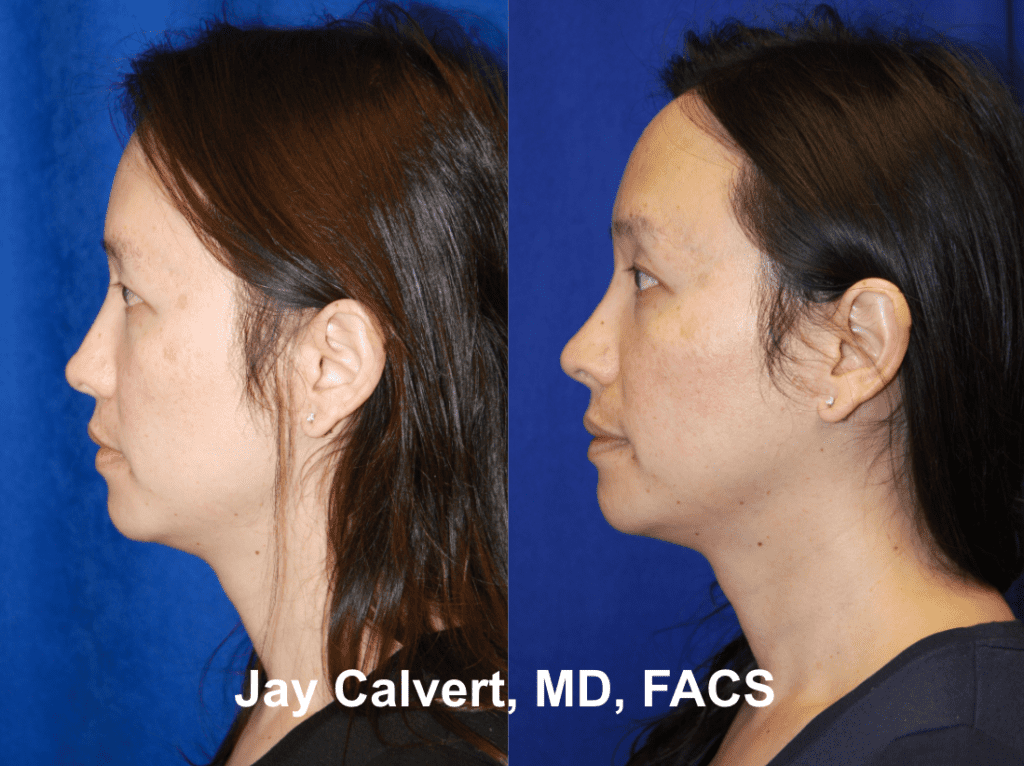 Revision Rhinoplasty with Rib by Dr. Calvert 4