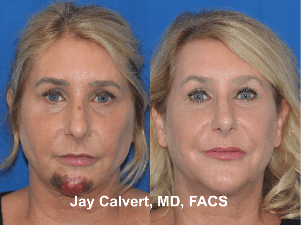 Primary Nasal Reconstruction by Dr. Jay Calvert 3c