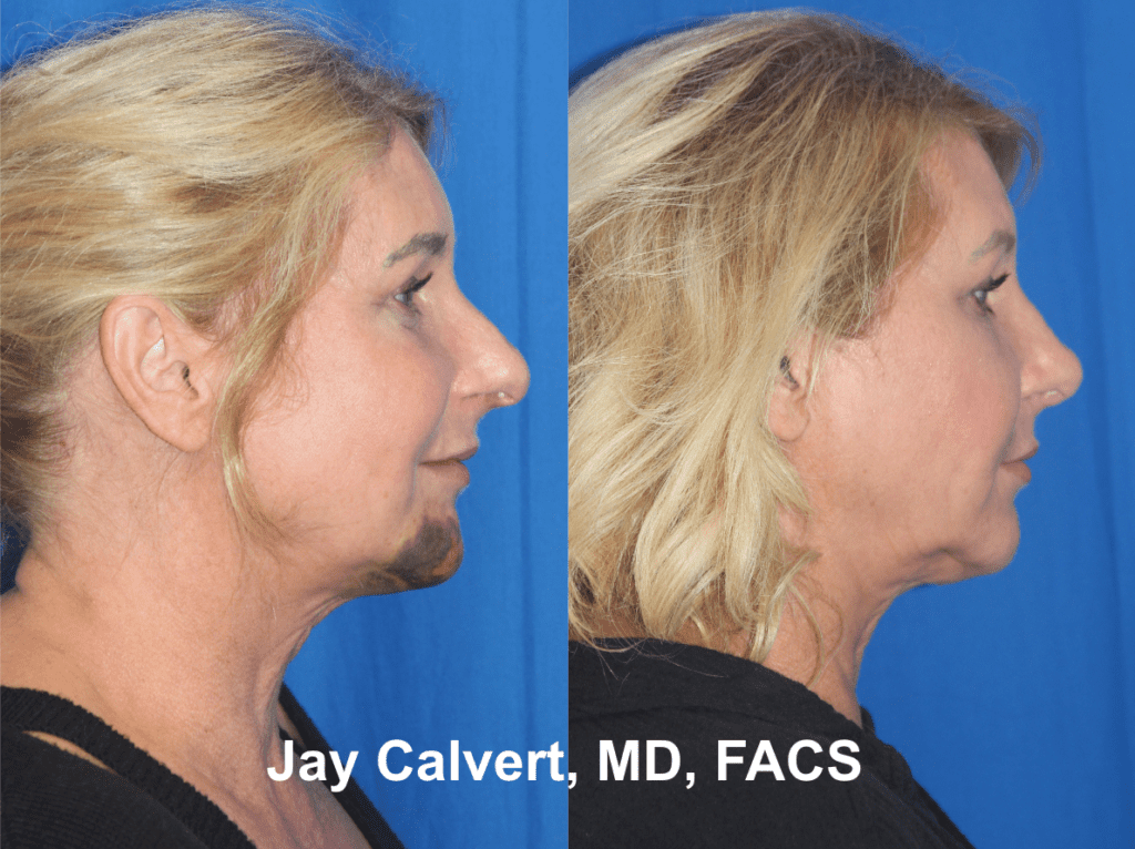 Primary Nasal Reconstruction by Dr. Jay Calvert 3b