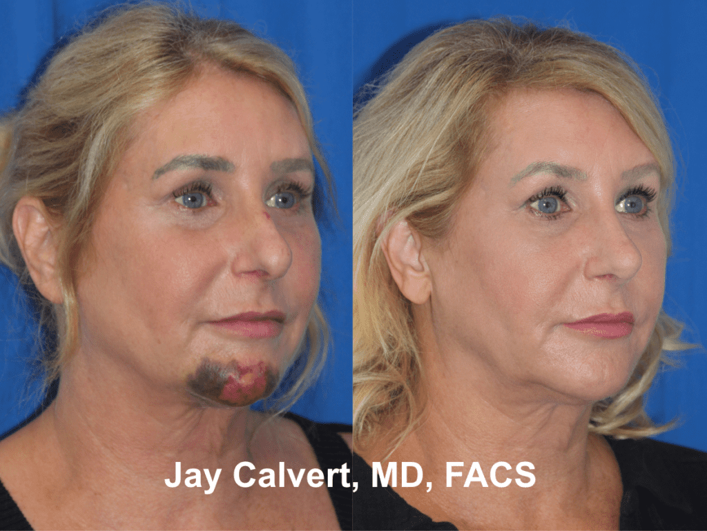 Primary Nasal Reconstruction by Dr. Jay Calvert 3a
