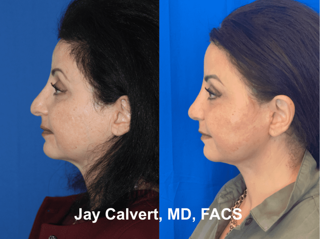 Revision Rhinoplasty and Lowerface and Neck Lift by Dr. Jay Calvert 3