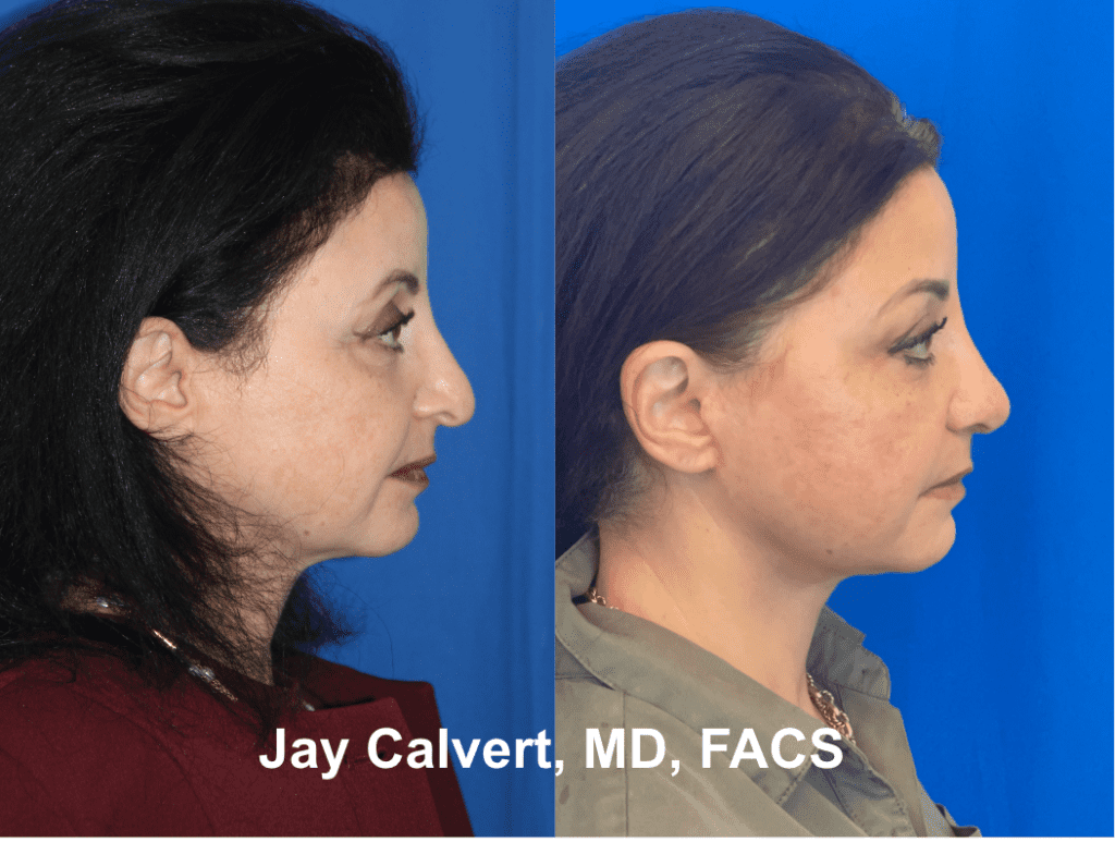Revision Rhinoplasty and Lowerface and Neck Lift by Dr. Jay Calvert 5