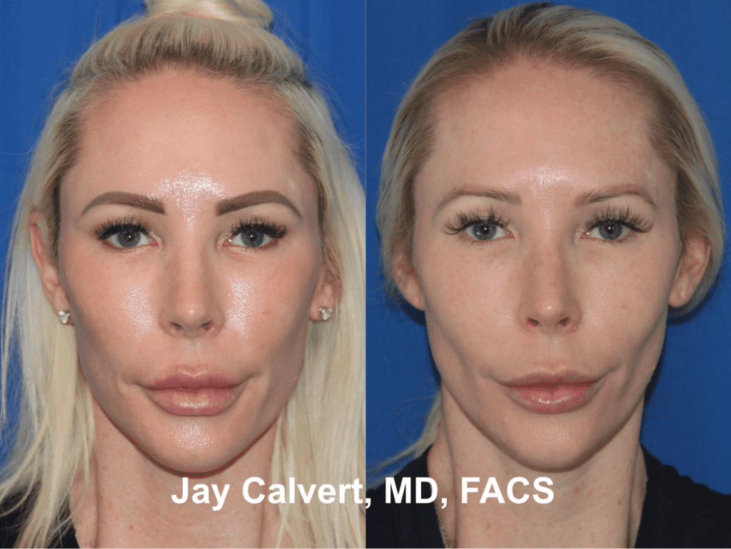 Endoscopic Midface and Lateral Brow Lift by Dr. Jay Calvert 4