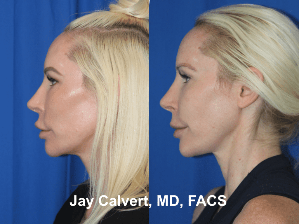 Endoscopic Midface and Lateral Brow Lift by Dr. Jay Calvert 1