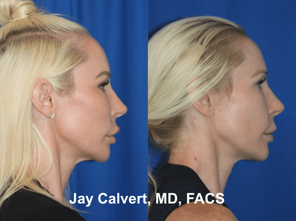 Endoscopic Midface and Lateral Brow Lift by Dr. Jay Calvert