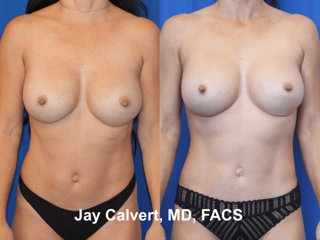 Body Liposuction by Dr. Jay Calvert 5