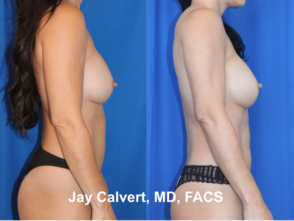 Liposuction by Dr. Jay Calvert 1a