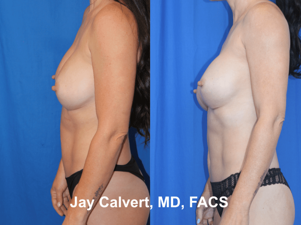 Liposuction by Dr. Jay Calvert 2a