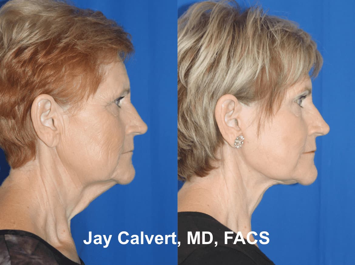 The Natural Lift​​™ by Dr Jay Calvert