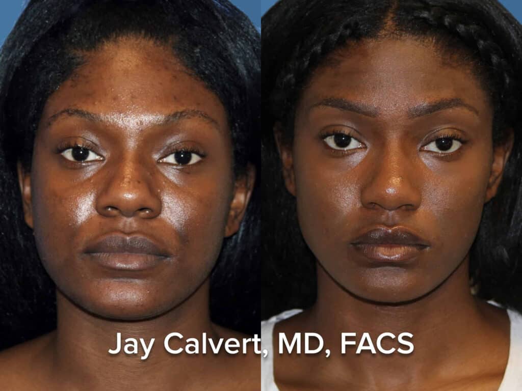 Best African American Rhinoplasty Surgeon in the USA