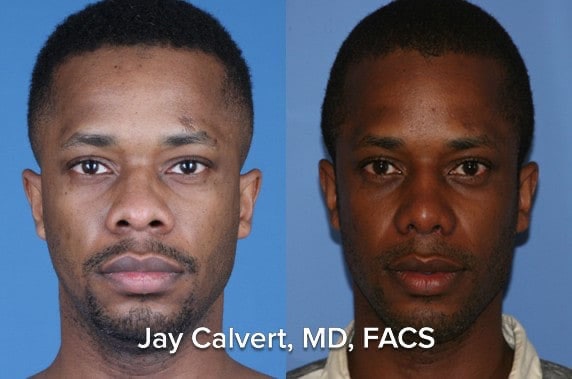 Best African American Rhinoplasty Surgeon in the USA