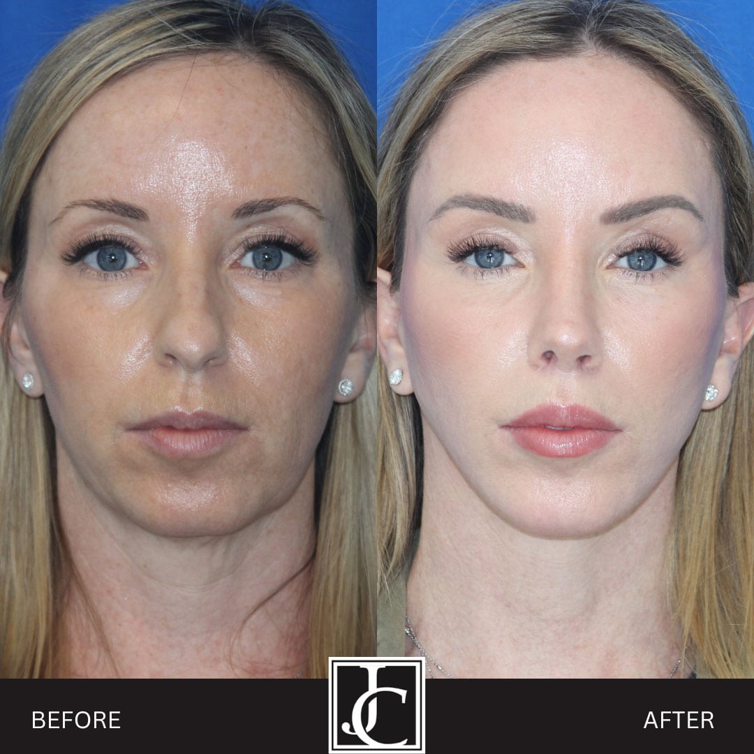Deep plane facelift before and after, front view, by Dr. Jay Calvert
