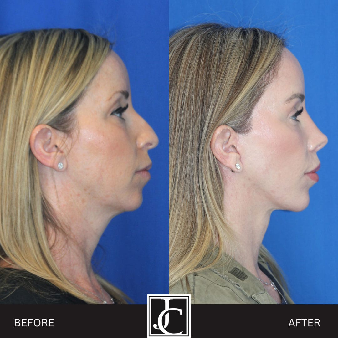 Deep plane facelift before and after, profile view, by Dr. Jay Calvert
