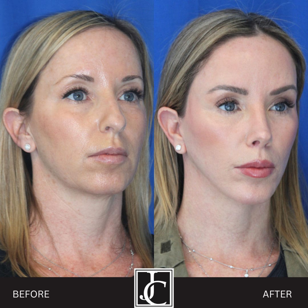 Deep plane facelift before and after, three-quarter view, by Dr. Jay Calvert